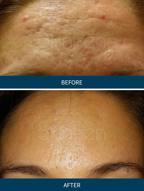 Chronic Care of Richmond offers affordable and effective Microneedling near you in Richmond.